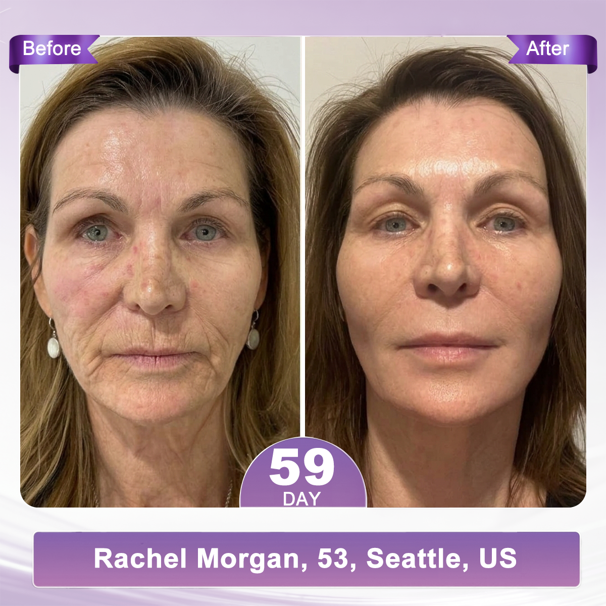 🇺🇸FDA Official: 𝐇𝐈𝐒𝐊𝐈𝐍® 𝐏𝐃𝐑𝐍 𝐌𝐮𝐥𝐭𝐢-𝐏𝐞𝐩𝐭𝐢𝐝𝐞 𝐌𝐚𝐬𝐬𝐚𝐠𝐢𝐧𝐠 𝐁𝐨𝐝𝐲 𝐑𝐨𝐥𝐥𝐞𝐫 𝐂𝐫𝐞𝐚𝐦- Anti-aging, Hydrating, Skin Firming & Lifting, Skin Repair, Even Tone, Acne and Dark Spot Treatment, Wart and Mole Removal, and Psoriasis Relief.